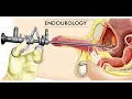 Laparoscopy ureterolithotomy CPT code - simplify medical coding