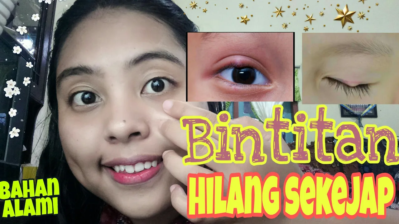 CARA MENGHILANGKAN MILIA / BINTIK PUTIH DI WAJAH. 