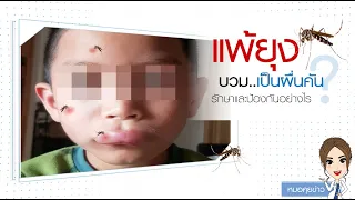 ยุงกัดแล้วปากบวมเจ่อจนเหมือนโดนัลดั๊กได้ไหม ทำไมถึงเกิดแบบนี้