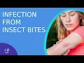 Skin Infection From Bug Bites - Daily Do s of Dermatology