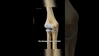 Elbow Replacement Surgery Explained In 3d animation