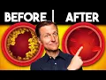 Download Lagu The Best MEAL to Clear Out Your Arteries