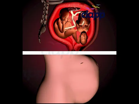 Twins fight Inside the Womb! ❤️ Pregnancy Animation