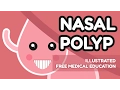 What is Nasal Polyp