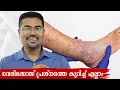 All About Varicose Problem - Dr Manoj Johnson