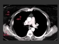 Understanding CT windows levels and densities