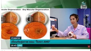 โรคจอประสาทตาเสื่อม หรือ AMD คืออะไร   และมีกี่ชนิด
