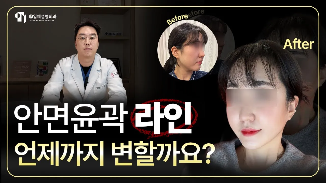 윤곽 수술 후 붓기, 진짜 1년까지 간다고?! 후기사진과 함께 알아보자👀✨