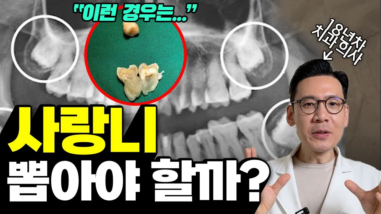 사랑니 뽑아야 돼 말아야 돼...? 이 영상으로 완벽 정리!