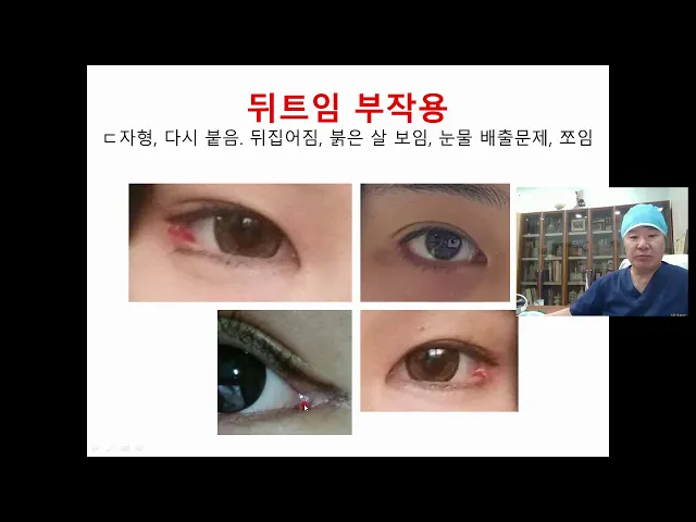 검판전진술을 이용한 뒤트임 수술