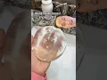 How Do You Get Mold Inside Breast Implants