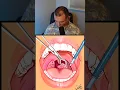 Tonsillectomy Cautery