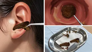 Relaxing Earwax Extraction | Ear cleaning | PUYA ASMR