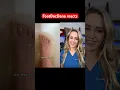 Doctor reacts parasites on your feet