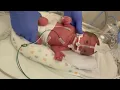 Download Lagu 1-pound preemie reunites with NICU team 1 year after discharge