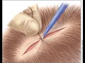 Complex Skin Repair CPT code - simplify medical coding