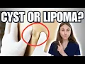 Lumps Under The Skin Cyst Vs Lipoma