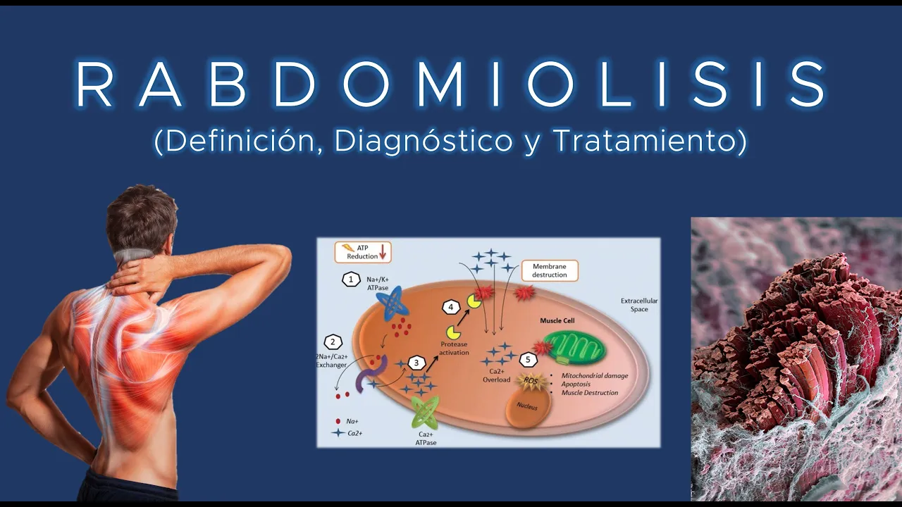 #Rabdomiolisis (Definición, Diagnóstico y Tratamiento)