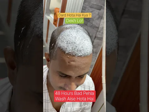 Hair Transplant Ke Baad Pehla Head Wash Kaise Hota Hai? 😱 Dard Hota Hai Kya? #shorts #headwash #day