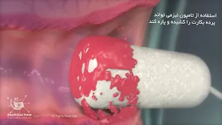پرده بکارت  پرده بکارت