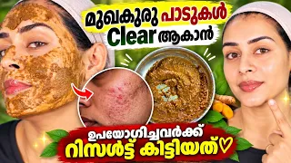 മുഖകുരു പാടുകൾ ഫുൾ മാറണോ|ഡെയിലി ഒരു സ്പൂൺ ഇത്‌ മതി| ടീനേജ് മുതൽ എല്ലാവർക്കും Result👌 #acne marks 
