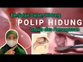 Download Lagu TIDAK SEMUA POLIP HIDUNG HARUS DI OPERASI - KENALI GEJALA POLIP HIDUNG