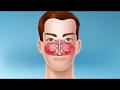 Why does the Upper Airway Collapse