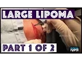 Dr Rebish excising a large lipoma from the neck - Part 1 Removal