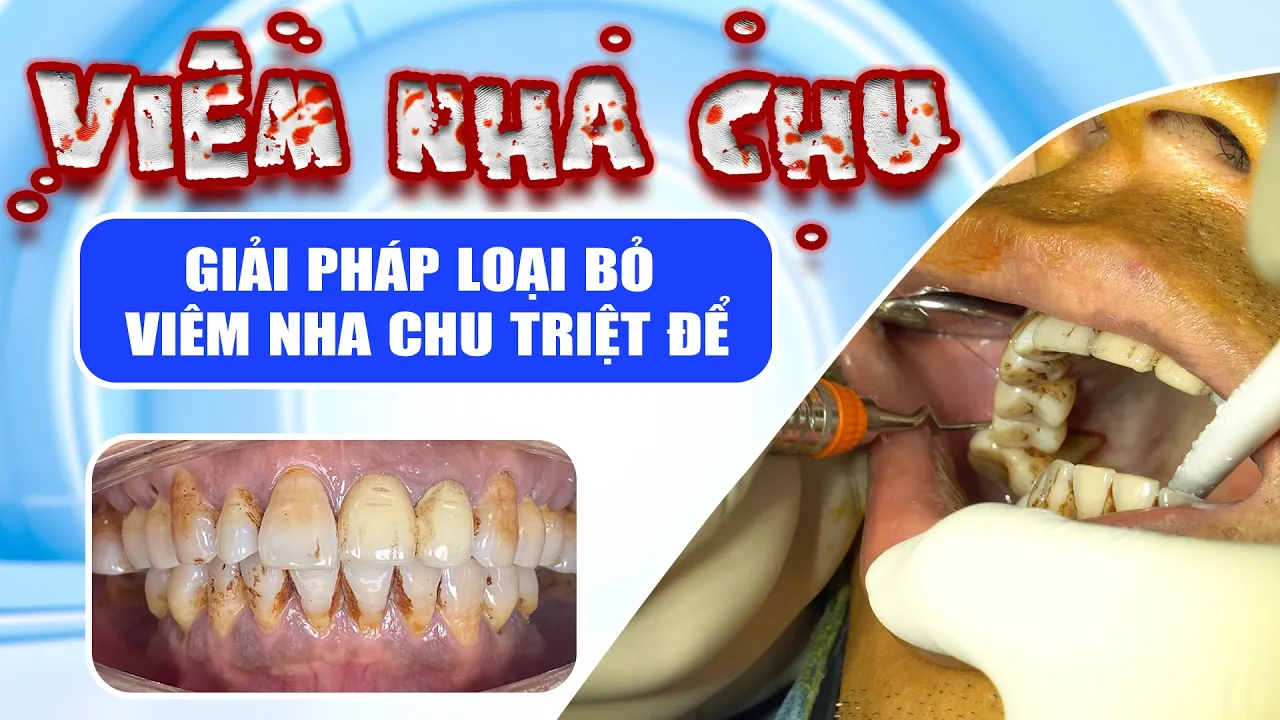 Outline Video Viêm Nha Chu - Giải Pháp Loại Bỏ Viêm Nha Chu Triệt Để | Nam Bùi Vinalign