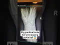 Download Lagu Our family is falling apart 😭😂 #broken  #pickleball #injury #xray #fyp