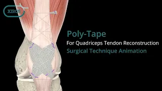 Poly-Tape for Quadriceps Tendon Reconstruction Surgical Technique Animation