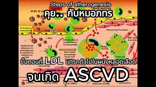  ทำไม LDL จึงถือว่าเป็นอันตรายต่อหลอดเลือด และมีผลต่อการเกิดโรคหัวใจได้อย่างไร 