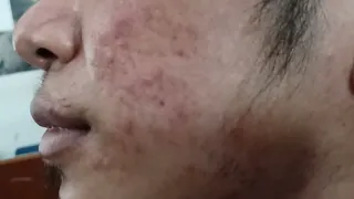 Inflammatory acne scars post inflammatory pigmentation Tinea Fasciei left cheek