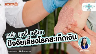 ผู้ป่วยสะเก็ดเงินควรดูแลตัวเองอย่างไรเพื่อควบคุมโรค