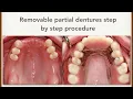 RPD step by step procedure