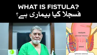 what is fistula information for a common man