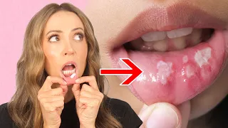 What Nicotine Pouches Do to Your Mouth