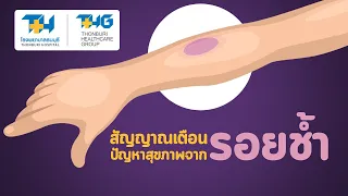 การขาดวิตามินใดบ้างที่ทำให้เกิดรอยฟกช้ำได้