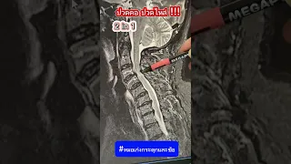  ทำไมถึงปวดคอและชาลงแขนข้างขวา 