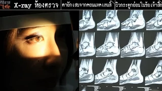 ทำไมการใส่คอนแทคเลนส์แบบรายเดือนถึงมีความเสี่ยงต่อการติดเชื้อสูงกว่าแบบรายวัน