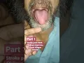 STROKE PADA LIDAH, BICARA LAMBAT, KAKU \u0026 TIDAK JELAS PART 1