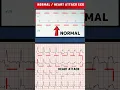 Download Lagu हार्ट अटैक का ECG - HEART ATTACK ECG VS NORMAL ECG#shorts