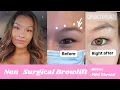 PDO thread Lift BOTOX