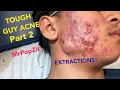 Very severe acne in a preteen patient Follow his progress Extractions of blackheads and whiteheads