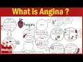 Pharmacology - What is Angina Pectoris ? Types of Angina, Symptoms, Causes \u0026Treatment FROM A TO Z