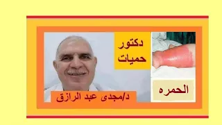 علاج الحمرة بالساق و الإلتهاب الخلوي TREATMENT OF ERYSIPELAS AND CELLULITIS 