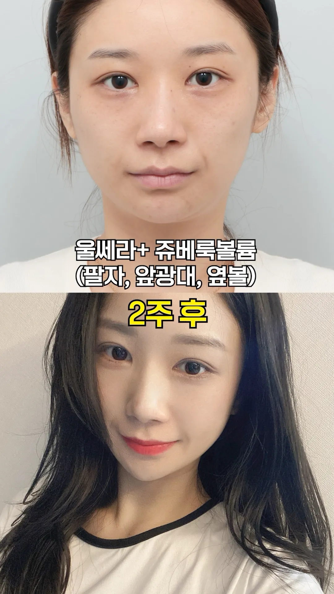 팔자주름이랑 이중턱 한 번에 해결한 조합