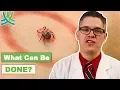 How To Treat Lyme Disease Bullseye Rash