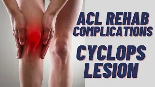 ACL Rehab Complication - CYCLOPS LESION