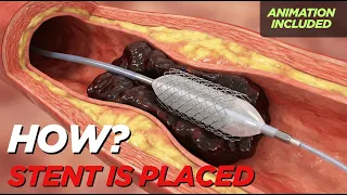 How Is a Stent Placed During a Heart Attack? | Procedure Explained